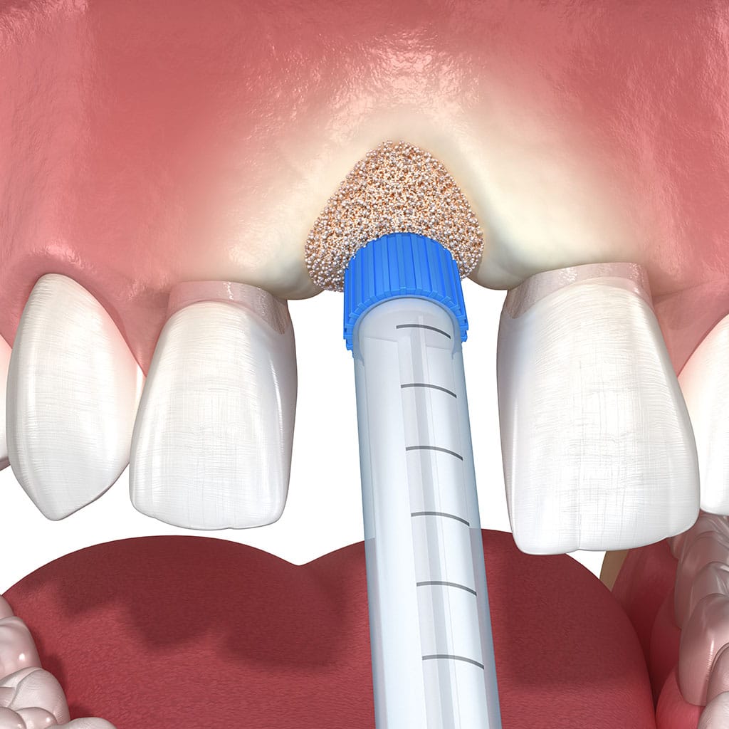 Bone grafting for dental implants with biomaterial application