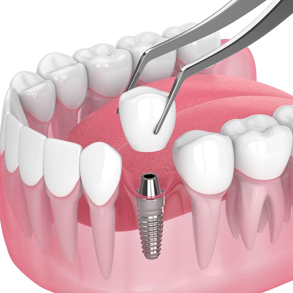 Bone grafting for dental implants